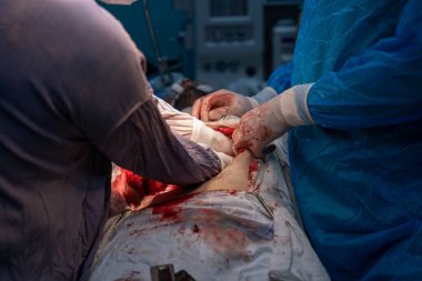 Bir cerrah bir hastanın midesini kesiyor. Hastanın kanaması var ve cerrah eldiven giyiyor.