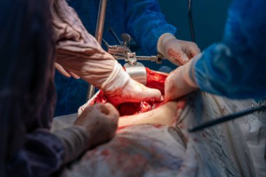 Bir grup cerrah bir hastaya ameliyat yapıyor. Cerrahlar görevlerine odaklandığı için sahne yoğun ve ciddi. Hasta masanın üzerinde yatıyor.