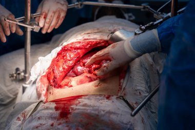 Bir cerrah bir hastanın midesini kesiyor. Hastanın kanaması var ve cerrah kanamayı durdurmaya çalışıyor. Sahne yoğun ve dramatik.