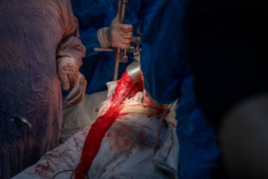 Bir cerrah bir hastanın vücudunu kesiyor. Hastanın kanaması var ve cerrah kanı kesmek için neşter kullanıyor. Sahne yoğun ve dramatik.