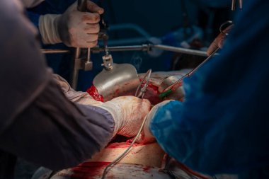 Bir grup cerrah bir hastaya ameliyat yapıyor. Cerrahlar görevlerine odaklandığı için sahne yoğun ve ciddi. Hasta bir hastane yatağında.