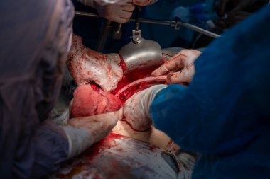 Bir grup cerrah bir hastaya ameliyat yapıyor. Olay yeri yoğun ve dramatik. Cerrahlar hastanın hayatını kurtarmak için birlikte çalışıyorlar.