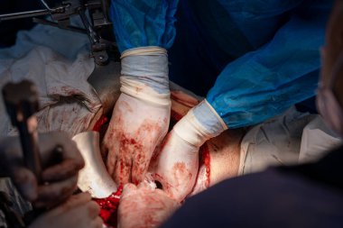 Bir cerrah bir hastaya ameliyat yapıyor. Hastanın kanaması var ve cerrah kanamayı durdurmaya çalışıyor. Sahne yoğun ve dramatik.