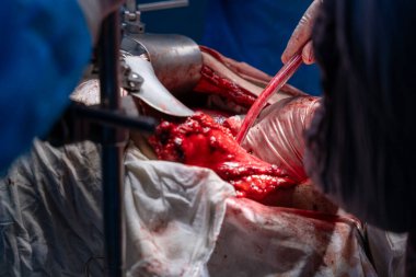 Bir cerrah bir hastanın vücudunu kesiyor. Hastanın kanaması var ve cerrah kanı boşaltmak için tüp kullanıyor. Sahne yoğun ve dramatik.