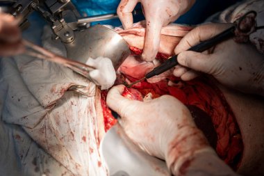 Bir cerrah bir hastanın midesini kesiyor. Olay yeri kanlı ve yoğun. Cerrah eldiven takıyor ve neşterle kesiyor.