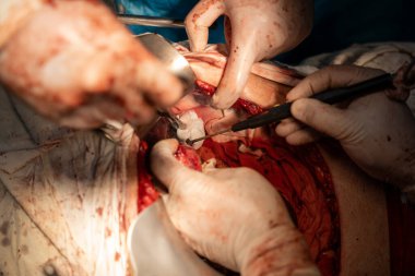 Bir cerrah bir hastanın midesini kesiyor. Olay yeri kanlı ve yoğun. Cerrah ve diğer tıp uzmanları hastanın hayatını kurtarmak için birlikte çalışıyorlar.