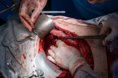 Bir cerrah bir hastanın midesini kesiyor. Olay yeri kanlı ve yoğun, cerrah eldiven takıyor ve neşterle kesiyor.