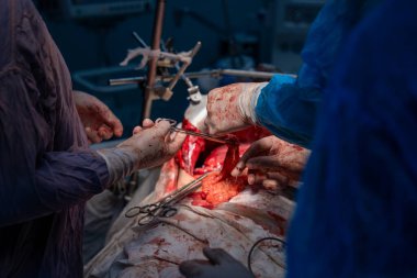 Bir grup cerrah bir hastaya ameliyat yapıyor. Cerrahlar hastanın vücudunu kesmek için keskin aletler kullandıkları için sahne yoğun ve dramatik. Atmosfer ciddi.