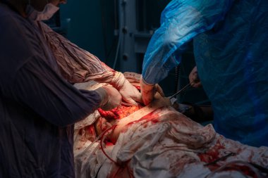 Bir cerrah bir hastanın midesini kesiyor. Cerrah hastanın hayatını kurtarmak için çalışırken sahne yoğun ve dramatik. Hastanın vücudundaki kan ve pıhtı aciliyet hissi yaratıyor.