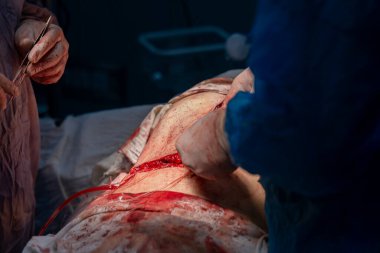 Bir adam bir insanın karnını deşiyor. Adam mavi bir ameliyat elbisesi ve eldiven giyiyor.