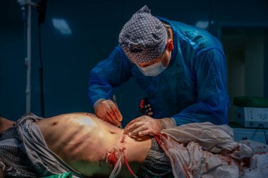 Mavi cerrahi kıyafetli bir adam bir adamın karnını kesiyor.