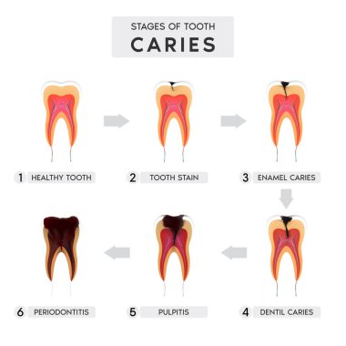 Diş bakımı yapısı ve ilerlemesi ve tedavisi: Diş İllüzyonu. Gerçekçi bir şekilde. Leke, diş mineleri, diş, pulpitis, periodontit. Vektör illüstrasyonu 3d.