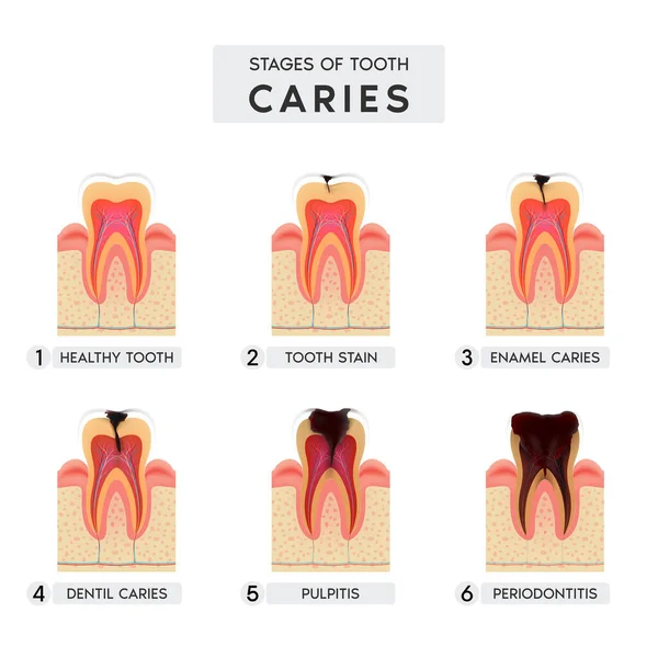 stock vector Tooth caries structure and Progression and Treatment: Dental Illustration. In realistic style. Stain, enamel caries, dentil, pulpitis, periodontitis. Vector illustration 3d.