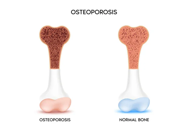 Gezonde Botten Ongezonde Botten Osteoporose Medisch Gezondheidsconcept Botbescherming Geïsoleerd Witte — Stockvector