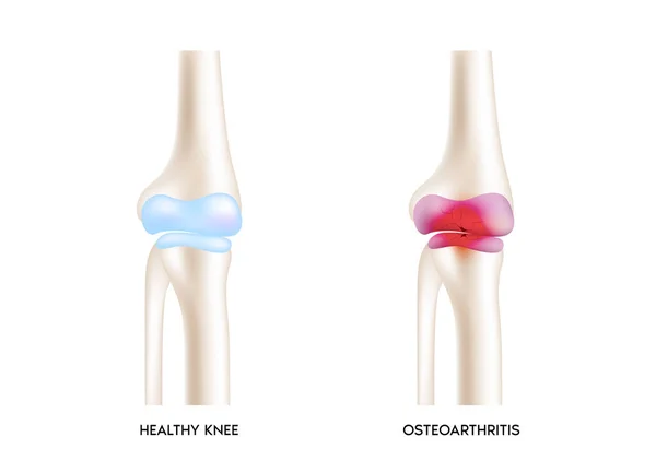 Knie Artrose Artritis Degeneratieve Gewrichtsziekte Kraakbeen Wordt Versleten Dat Resulteert — Stockvector