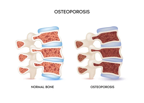 Kości Kręgosłupa Zdrowa Niezdrowa Kość Osteoporoza Koncepcja Medyczna Lub Zdrowotna — Wektor stockowy