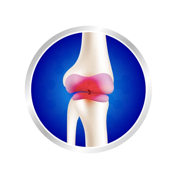 Štítku Hliníkové Koleno Osteoartritidy Artritida Nebo Degenerativní Onemocnění Kloubů Výsledkem — Stockový vektor