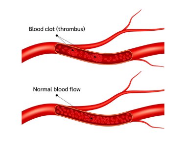 İnsan kan damarlarında kan pıhtısı (trombus). Yüksek Idl ve HDL seviyesi. Arterioskleroz kan riski ve normal kan akışı. Beyaz bir arka planda izole edilmiş. 3B Vektör illüstrasyonu.