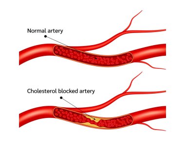 Normal blood flow and Cholesterol artery thrombosis microvascular disease. In human blood vessels. High ldl and hdl level. Arteriosclerosis blood risk. 3D Vector illustration. clipart