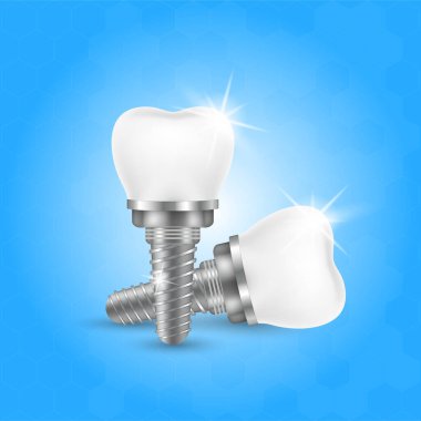 Stomatoloji seti için diş ve diş implantı. İmplant yapı modelleri. Takma diş taktırmayı siktir et. Stomatoloji kliniği konsepti. Gerçekçi izole edilmiş 3 boyutlu vektör çizimi.