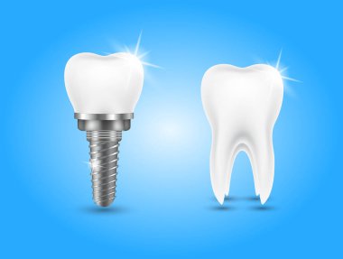 Stomatoloji seti için diş ve diş implantı. İmplant yapı modelleri. Takma diş taktırmayı siktir et. Stomatoloji kliniği konsepti. Gerçekçi izole edilmiş 3 boyutlu vektör çizimi.