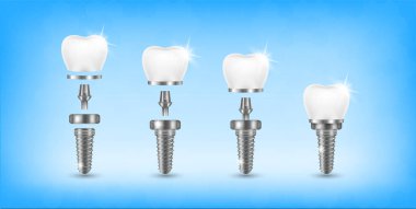 Stomatoloji seti için diş ve diş implantı. İmplant yapı modelleri. Takma diş taktırmayı siktir et. Stomatoloji kliniği konsepti. Gerçekçi izole edilmiş 3 boyutlu vektör çizimi.