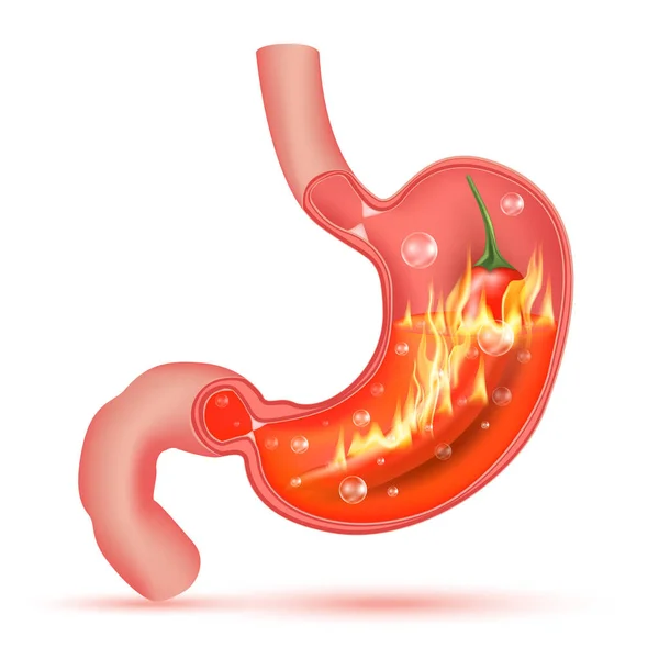 赤唐辛子の火 胃酸と胃 スパイシーな食品胃炎 健康食品栄養の概念 白い背景に隔離されている リアルな3Dベクトルイラスト — ストックベクタ
