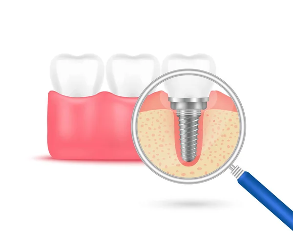 Хірургічний Моляр Заміною Зубного Імплантату Яснах Хороших Зубів Здорових Зубів — стоковий вектор