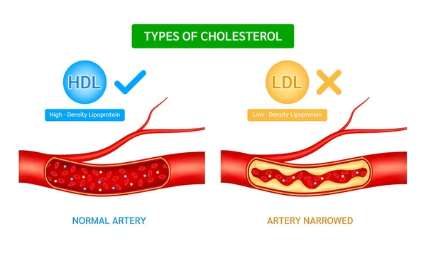 Typer Kolesterol Jämfört Med Hdl Lipoprotein Med Hög Densitet Och — Stock vektor