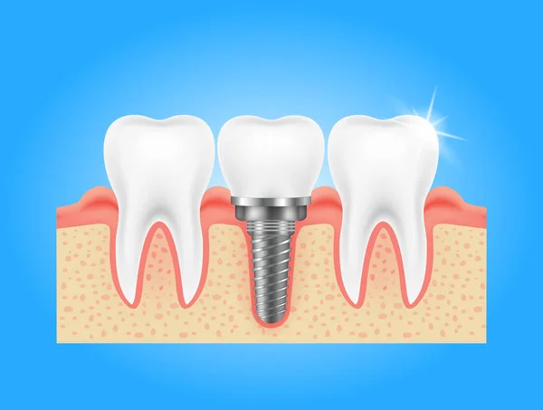 Хирургический Коренной Зуб Заменой Зубного Имплантата Десне Здоровых Зубов Черту — стоковый вектор