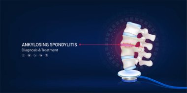 Ankylosing spondilit, insan omurga diski kıkırdak modeli steteskoptan uzaklaşır. Doktor teşhisi. Tıbbi teknoloji yenilik kavramı. Eczane kliniği için pankart tasarımı. 3d Vektör