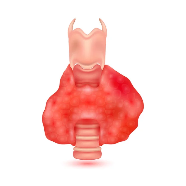 Гипертиреоз Анатомия Щитовидной Железы Человека Выделенная Белом Фоне Главный Орган — стоковый вектор