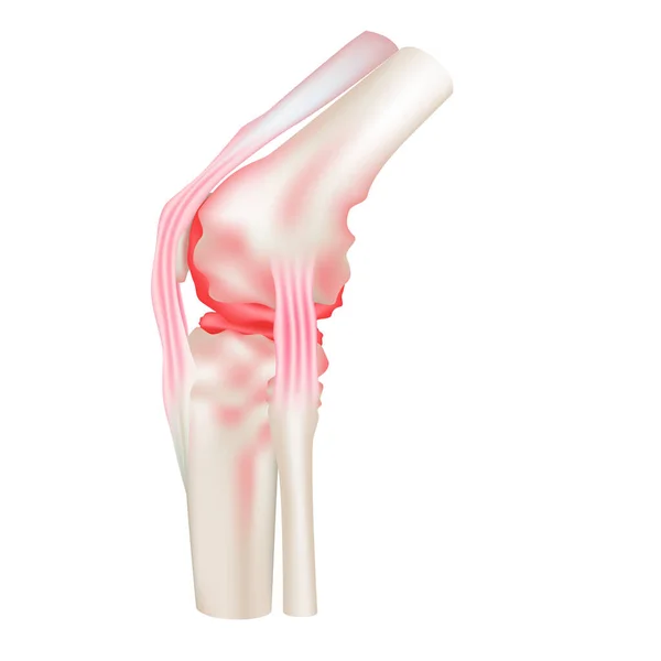 Artritis Reumatoide Modelo Cartílago Rojo Articulación Ósea Humana Aislado Sobre — Vector de stock