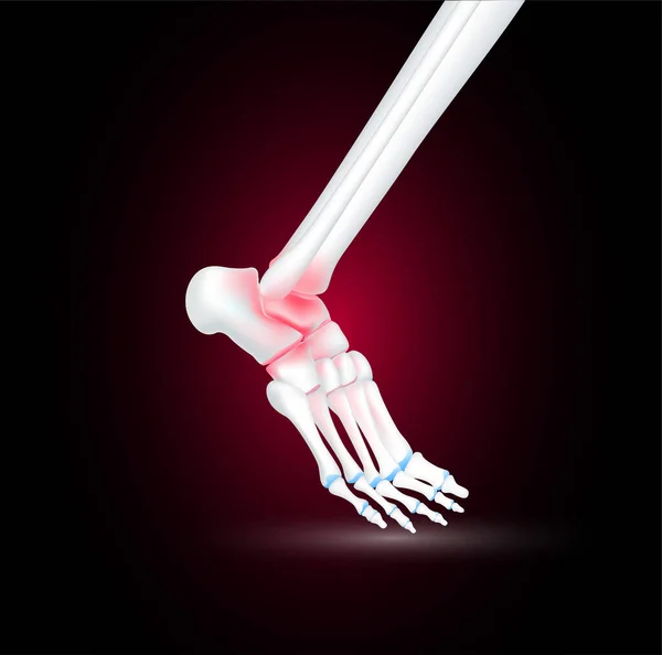 骨の足のトラウマおよび関節炎の関節軟骨の側面は黒い背景にあります 人間の骨格解剖学は健康である 医療医療科学コンセプト 現実的な3Dベクトル — ストックベクタ