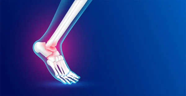 Trauma Kaki Ankle Bone Foot Dan Artritis Adalah Tulang Rawan - Stok Vektor