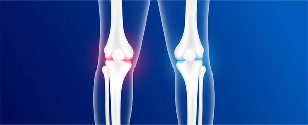 Tulang Sehat Dan Osteoartritis Atau Penyakit Sendi Degeneratif Sakit Sendi - Stok Vektor