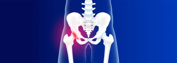 Heupbeen Bekken Gezond Degeneratieve Gewrichtsziekte Artritis Heuppijn Kraakbeen Wordt Versleten — Stockvector