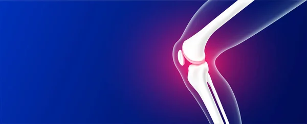 Des Jambes Inflammation Cartilage Articulaire Genou Sur Fond Bleu Avec — Image vectorielle