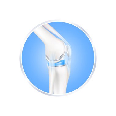 label aluminum. Knee replacement surgery total implant for treatment relieve arthritis, after joint damaged. Leg bone and side. Isolated on white background for product design. Realistic 3d vector. clipart