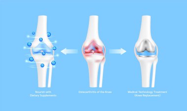 Bacak kemiği ve kıkırdak bağ dokusu. Kemik erimesi veya eklem iltihabı. Beslenme takviyeleri ve Yenilik Tıbbi Teknolojisi ile beslenmek. Diz ameliyatı ya da implant. 3B vektör.