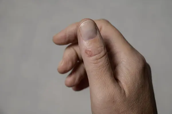 Başparmağında taze bir yara var..