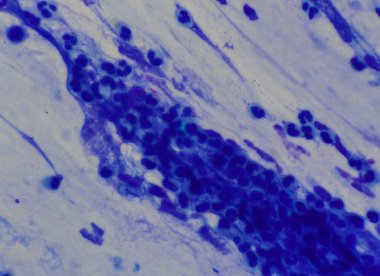 Mikroskop altında Mycobacterium tüberküloz görüntüsü kırmızı ve AFB lekeli.