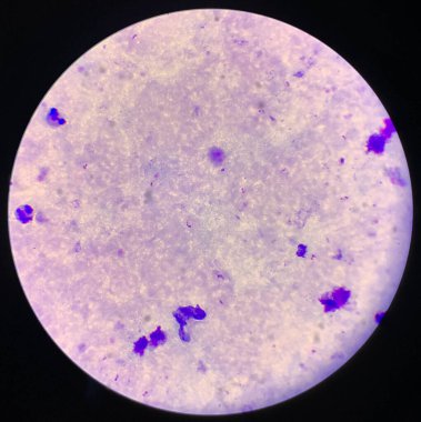 Sıtma paraziti plazma falciparum. Mikroskop altında kan lekesi var.