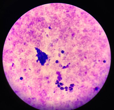 Sıtma paraziti plazma falciparum. Mikroskop altında kan lekesi var.