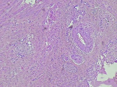 Patoloji laboratuvarında mikroskop altında insan yumurtalık kist hücre dokusunun geçmişi. Mikroskobik olarak pozitif rahim ağzı adenokarsinomuna, H ve E tarafından doku bölümlerine bak