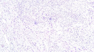 Photomicrograph of schwannoma in cpa tumor, a benign soft tissue tumor of the peripheral nervous system. clipart