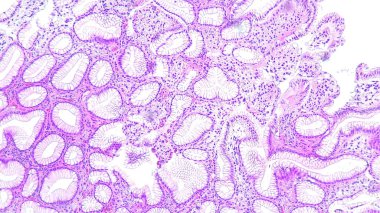 İnsan hücre dokusu mikroskop altında patoloji laboratuvarında. Kronik mide hastalığının mikroskobik resmi