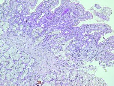 Human cell tissue under microscope in pathology laboratory. Microscopic picture of chronic gastric disease showing Helicobacter pylori bacterial infection, hematoxylin eosin staining clipart