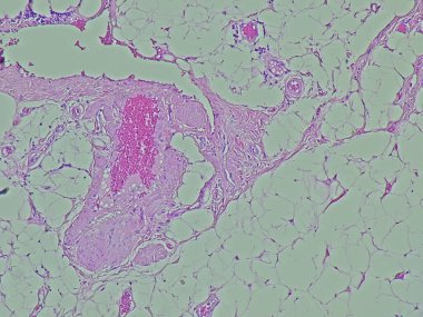 tumor regio thoracalis posterior, microscopic image of a lipofibroma, benign tumor in the anatomical pathology laboratory clipart