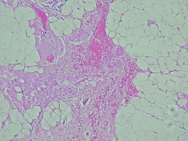 tumor regio thoracalis posterior, microscopic image of a lipofibroma, benign tumor in the anatomical pathology laboratory clipart